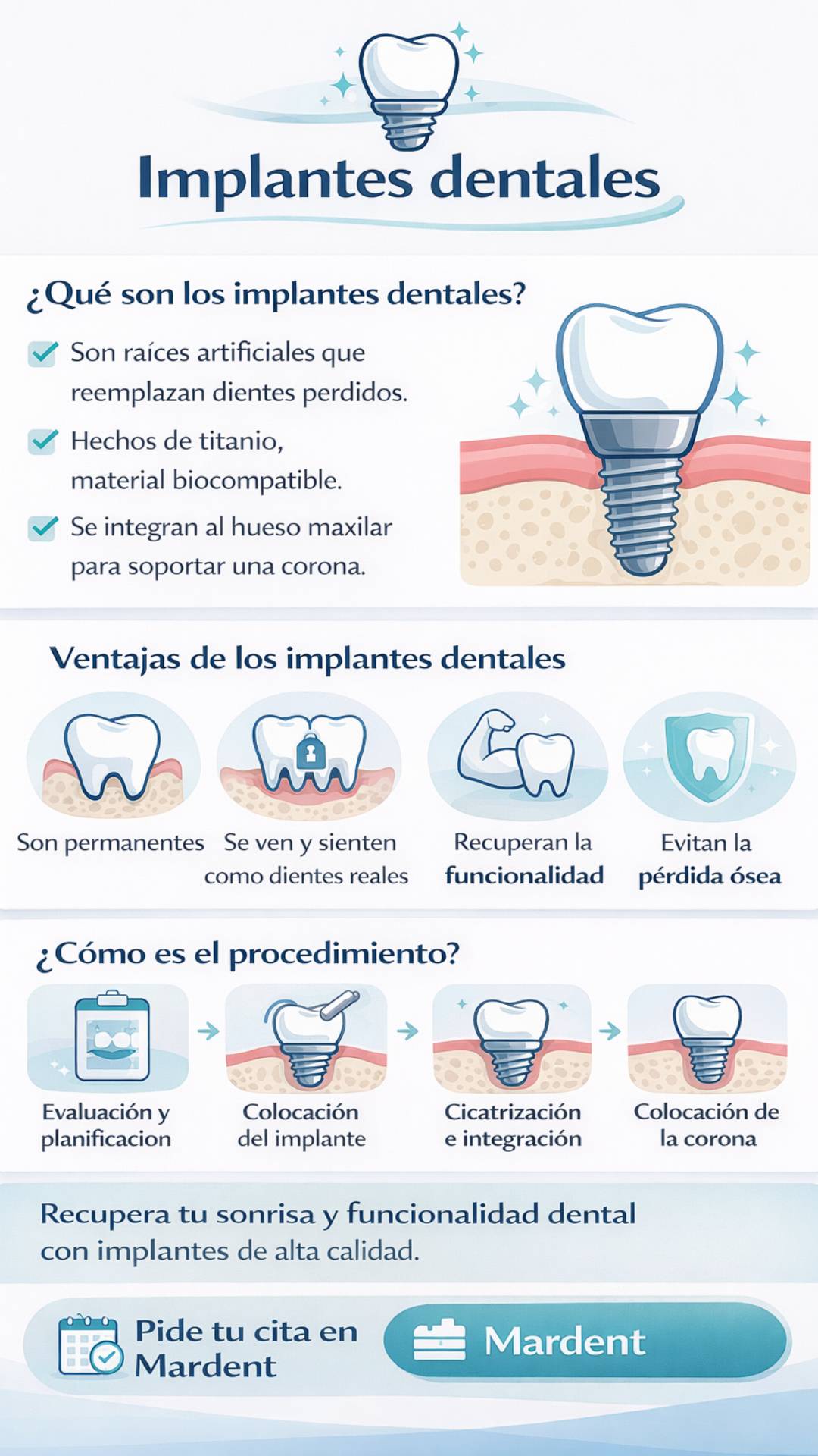 infografia informativa implantes dentales